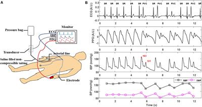 Continuous Blood Pressure Estimation From Electrocardiogram and Photoplethysmogram During Arrhythmias